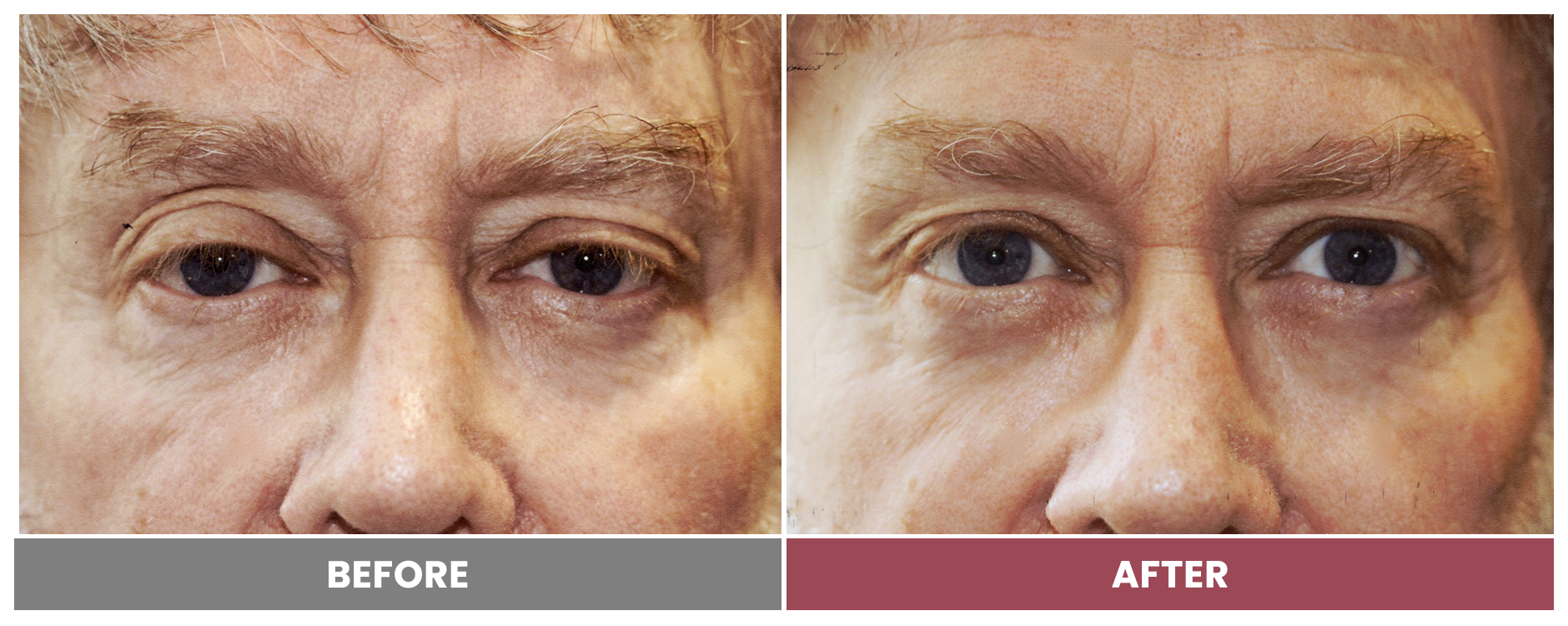 PTOSIS REPAIR - Case 34